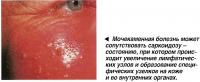 Мочекаменная болезнь может сопутствовать саркоидозу