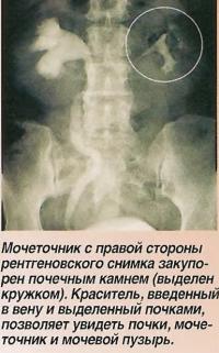 Мочеточник с правой закупорен почечным камнем