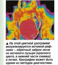 Мочевой рефлюкс - обратный заброс мочи из мочевого пузыря в почки