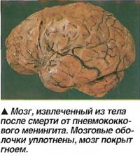 Мозг, извлеченный из тела после смерти от пневмококкового менингита
