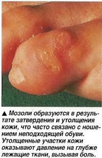 Мозоли образуются в результате затвердения и утолщения кожи