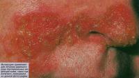 Мупироцин применяют для лечения широкого ряда бактериальных инфекций кожи