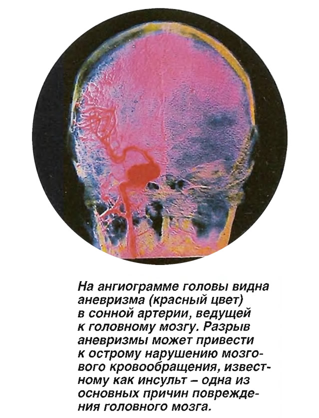 На ангиограмме головы видна аневризма (красный цвет) в сонной артерии