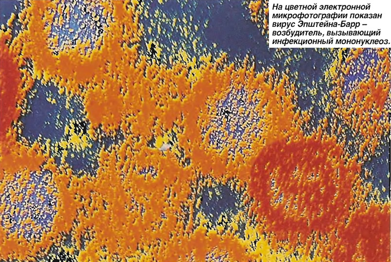 На цветной электронной микрофотографии показан вирус Эпштейна-Барр