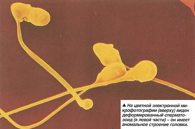 На цветной электронной микрофотографии виден деформированный сперматозоид