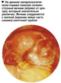 На данном лапароскопическом снимке показан поликистозный яичник