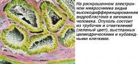 На электронном микроснимке видна андробластома в яичниках человека