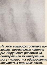 На этом микрофотоснимке показаны нормальные капилляры