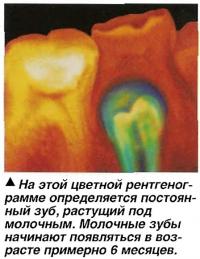 На этой цветной рентгенограмме определяется постоянный зуб, растущий под молочным