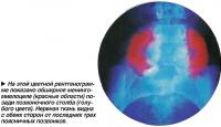 На этой цветной рентгенограмме показано обширное менингомиелоцеле