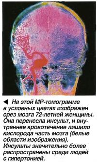 На этой МР-томограмме в условных цветах изображен срез мозга 72-летней женщины