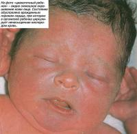 На фото «цианотичный ребенок» - видно синюшное окрашивание кожи лица