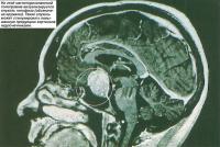 На магниторезонансной томограмме визуализируется опухоль гипофиза