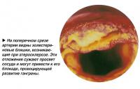 На поперечном срезе артерии видны холестериновые бляшки