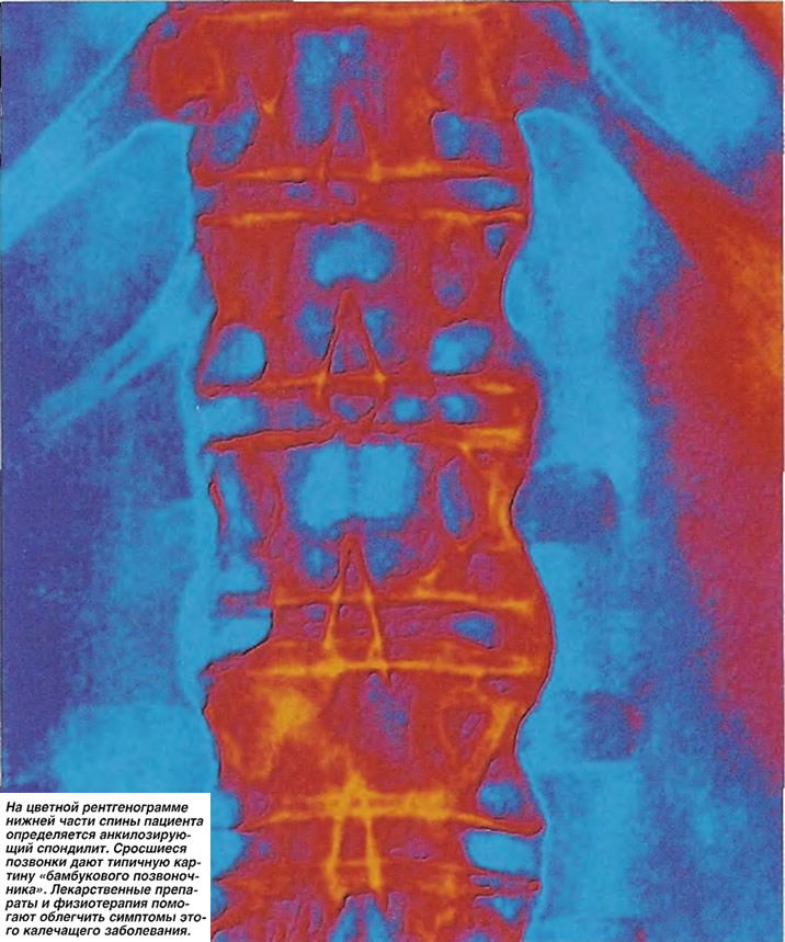 На рентгенограмме нижней части спины определяется анкилозирующий спондилит