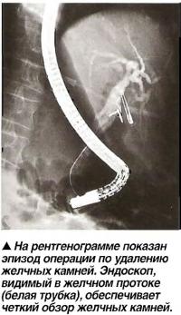 На рентгенограмме показан эпизод операции по удалению желчных камней