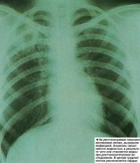 На рентгенограмме показано воспаление легких, вызванное инфекцией