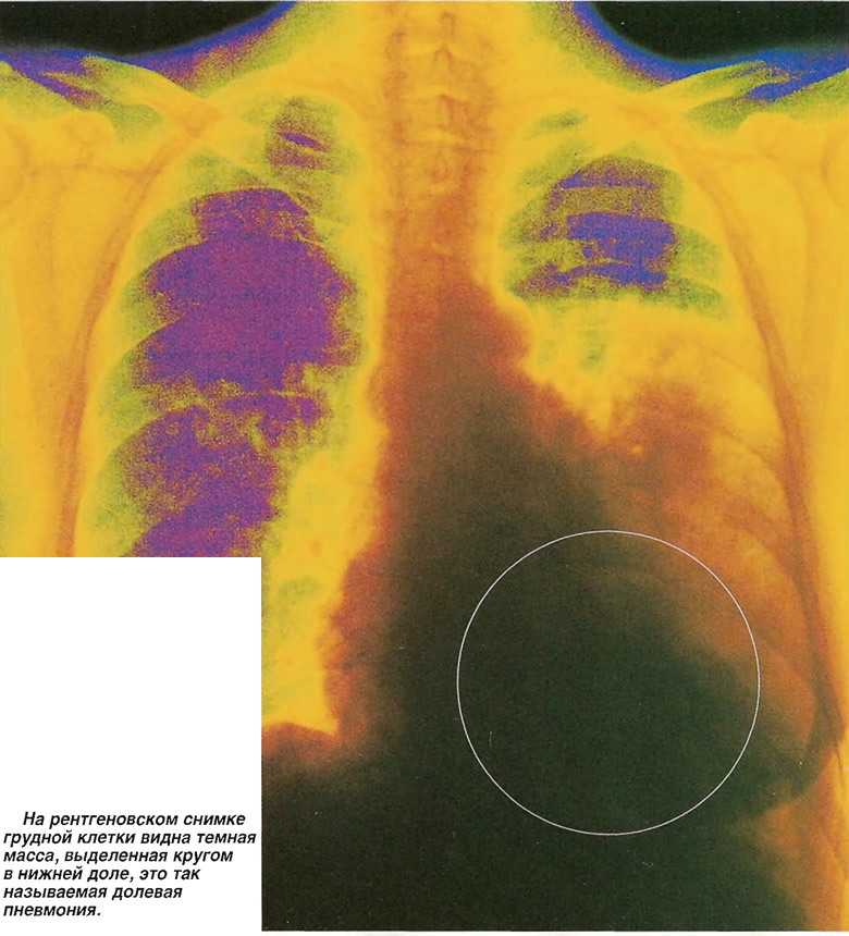 На рентгеновском снимке грудной клетки видна темная масса