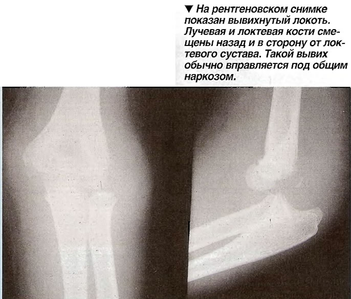 На рентгеновском снимке показан вывихнутый локоть