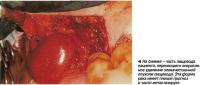 На снимке - часть пищевода пациента, перенесшего оперативное удаление злокачественной опухоли