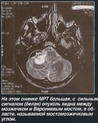 На снимке МРТ большая с сильным сигналом опухоль