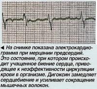 На снимке показана электрокардиограмма при мерцании предсердий