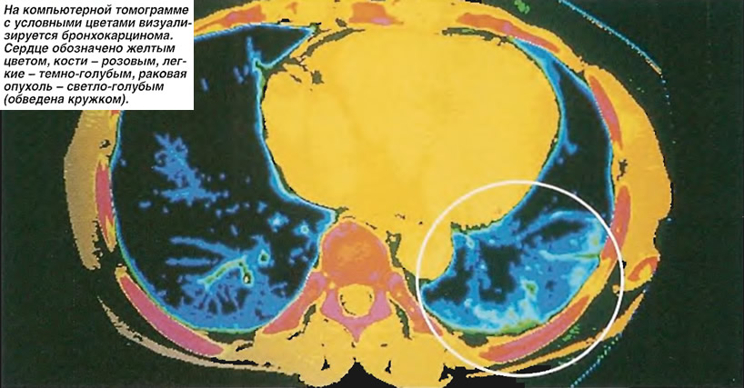 На томограмме с условными цветами визуализируется бронхокарцинома