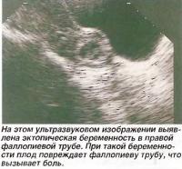На ультразвуковом изображении эктопическая беременность в правой фаллопиевой трубе