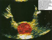 На ультразвуковой сканограмме показана простата под мочевым пузырем