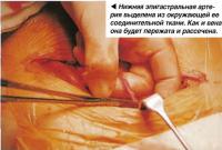 Нижняя эпигастральная артерия