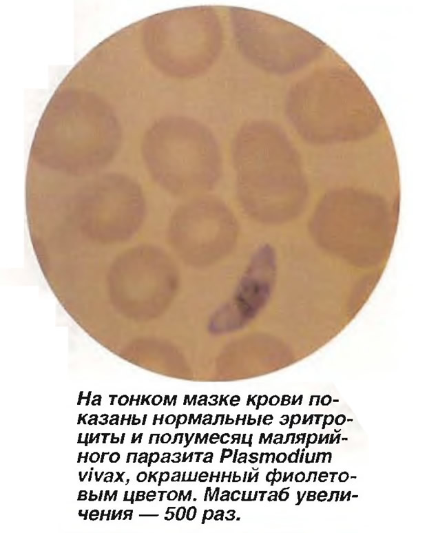 Нормальные эритроциты и полумесяц малярийного паразита Plasmodium vivax