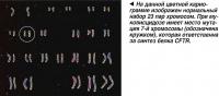 Нормальный набор 23 пар хромосом