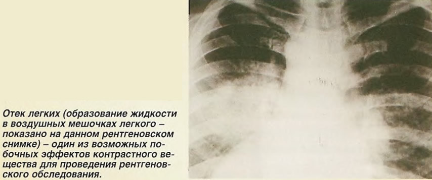 Образование жидкости в воздушных мешочках легкого показано на рентгеновском снимке