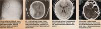 Осложнения травм головы, требующие краниотомии