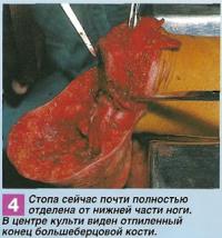 Отпиленный конец большеберцовой кости