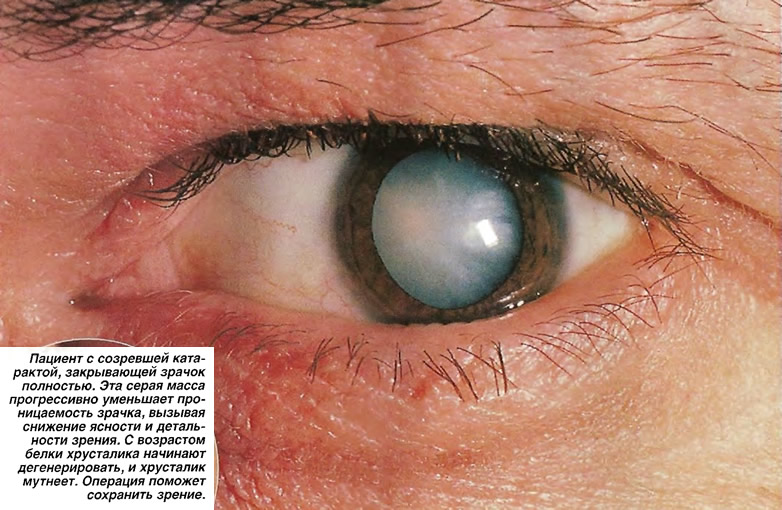 Пациент с созревшей катарактой, закрывающей зрачок полностью