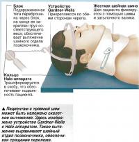 Пациентам с травмой шеи может быть наложено скелетное вытяжение