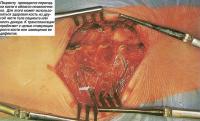 Пациенту проводится пересадка кости в области позвоночника