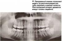 Панорамный снимок позволяет видеть на рентгенограмме все зубы верхней и нижней челюсти