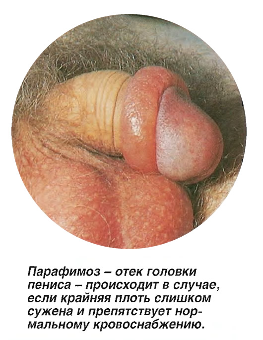 Парафимоз - отек головки пениса.