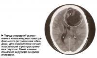 Перед операцией выполняется компьютерная томография мозга