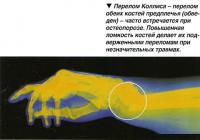 Перелом Коллиса - перелом обеих костей предплечья