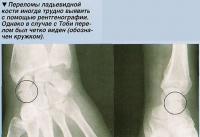 Переломы ладьевидной кости иногда трудно выявить с помощью рентгенографии
