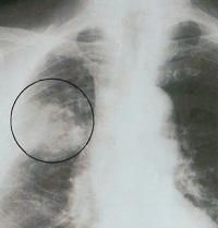 Пневмония на простой рентгенограмме
