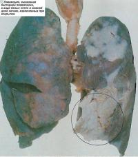 Пневмония, вызванная бактерией пневмококк, в виде белых пятен