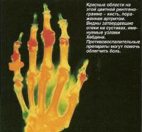 Пораженная артритом кисть