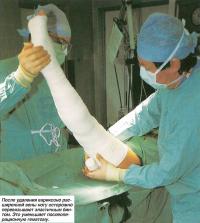 После удаления вены ногу перевязывают эластичным бинтом