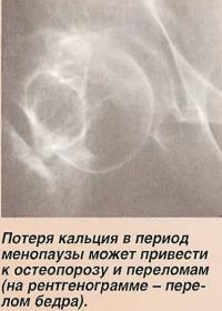 Потеря кальция в период менопаузы может привести к остеопорозу
