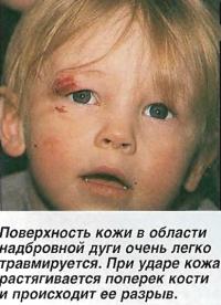 Поверхность кожи в области надбровной дуги очень легко травмируется