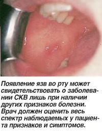 Появление язв во рту может свидетельствовать о заболевании СКВ